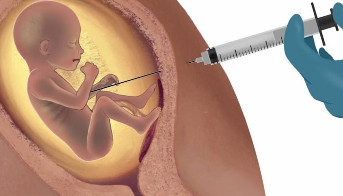 Assistolia fetal: procedimento que injeta cloreto de potássio no bebê dentro da barriga. (Foto:...